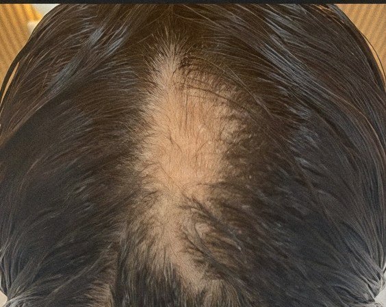 Scalp from above, 1st session
