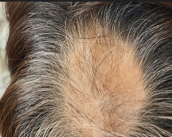 Scalp from above, 2nd session