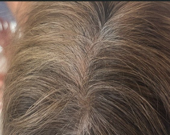 Scalp from above, 5th session