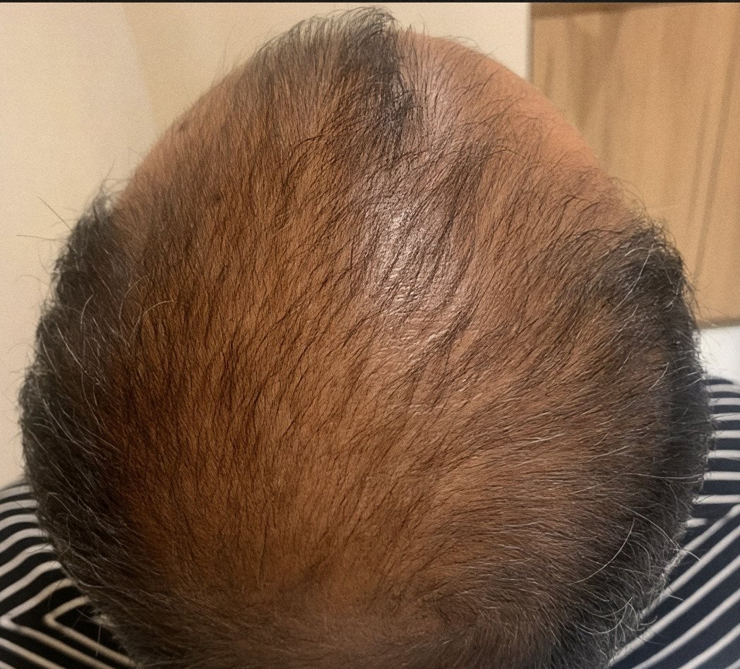 PRP Hair Renewal case 5: scalp from above, 1st session