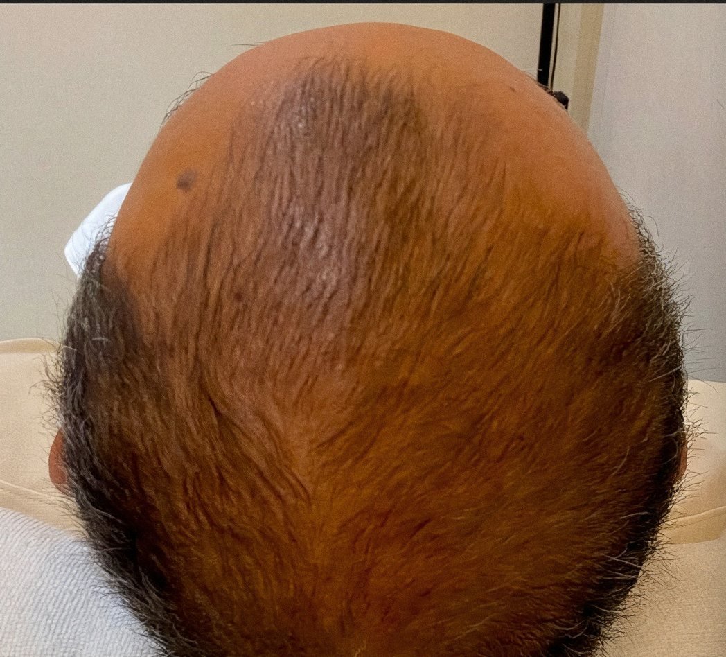 PRP Hair Renewal case 5: scalp from above, 2nd session