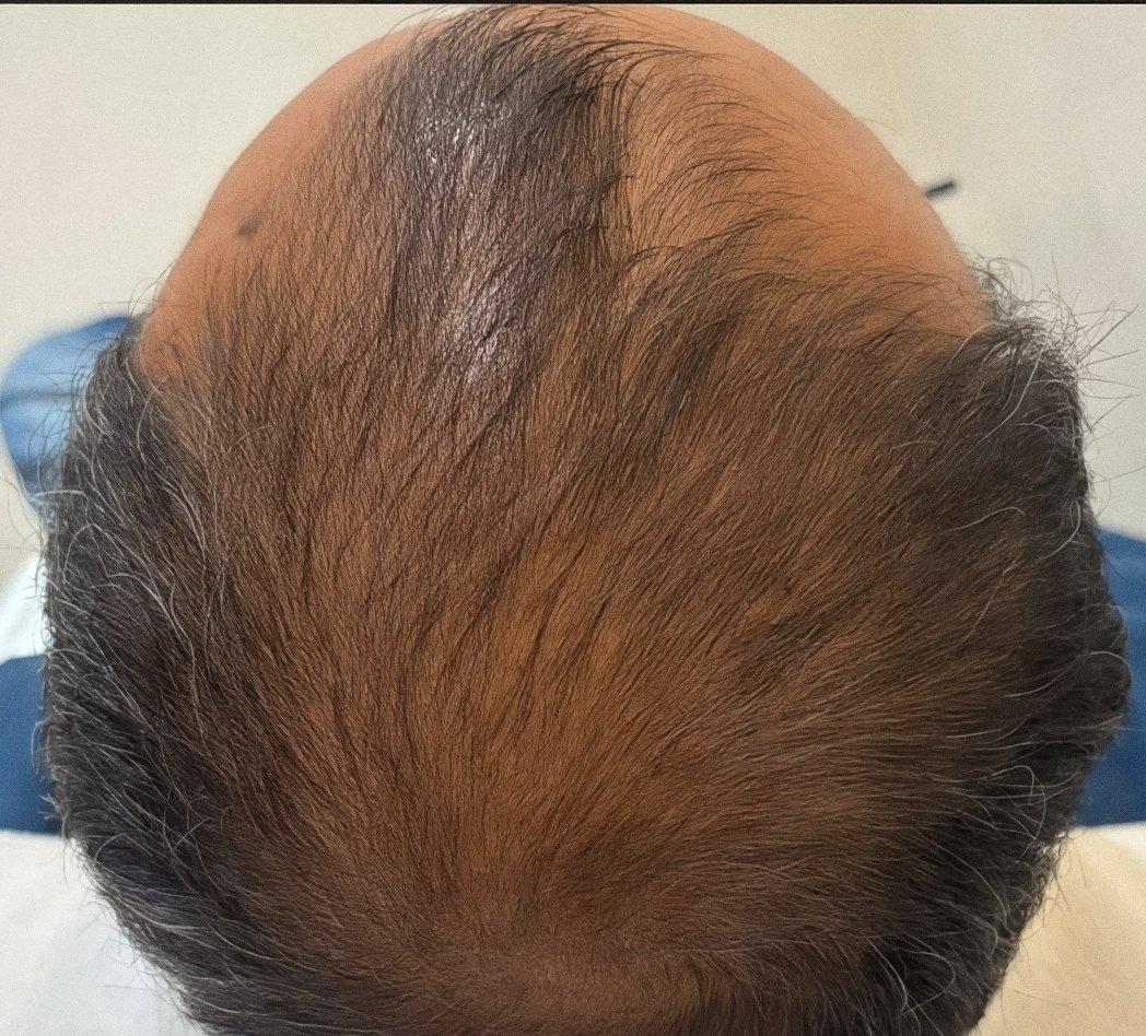 PRP Hair Renewal case 5: scalp from above, 3rd session