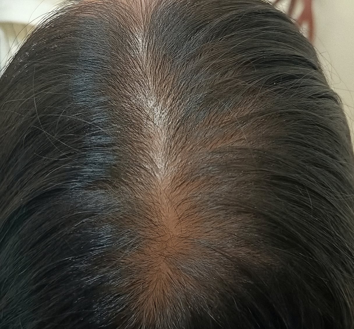 PRP Hair Renewal case 2: scalp from above, 3rd session