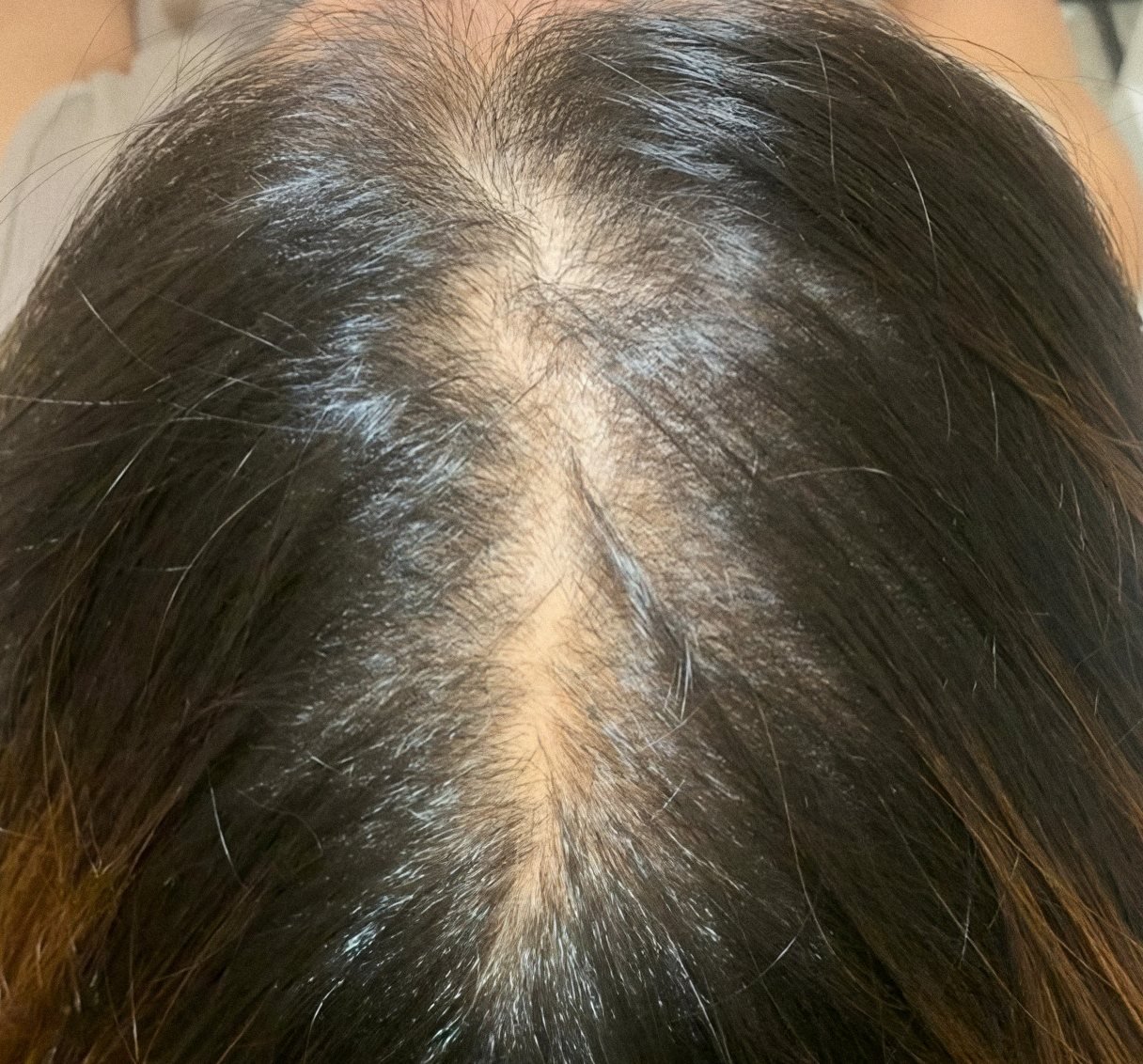 PRP Hair Renewal case 2: scalp from above, before treatment