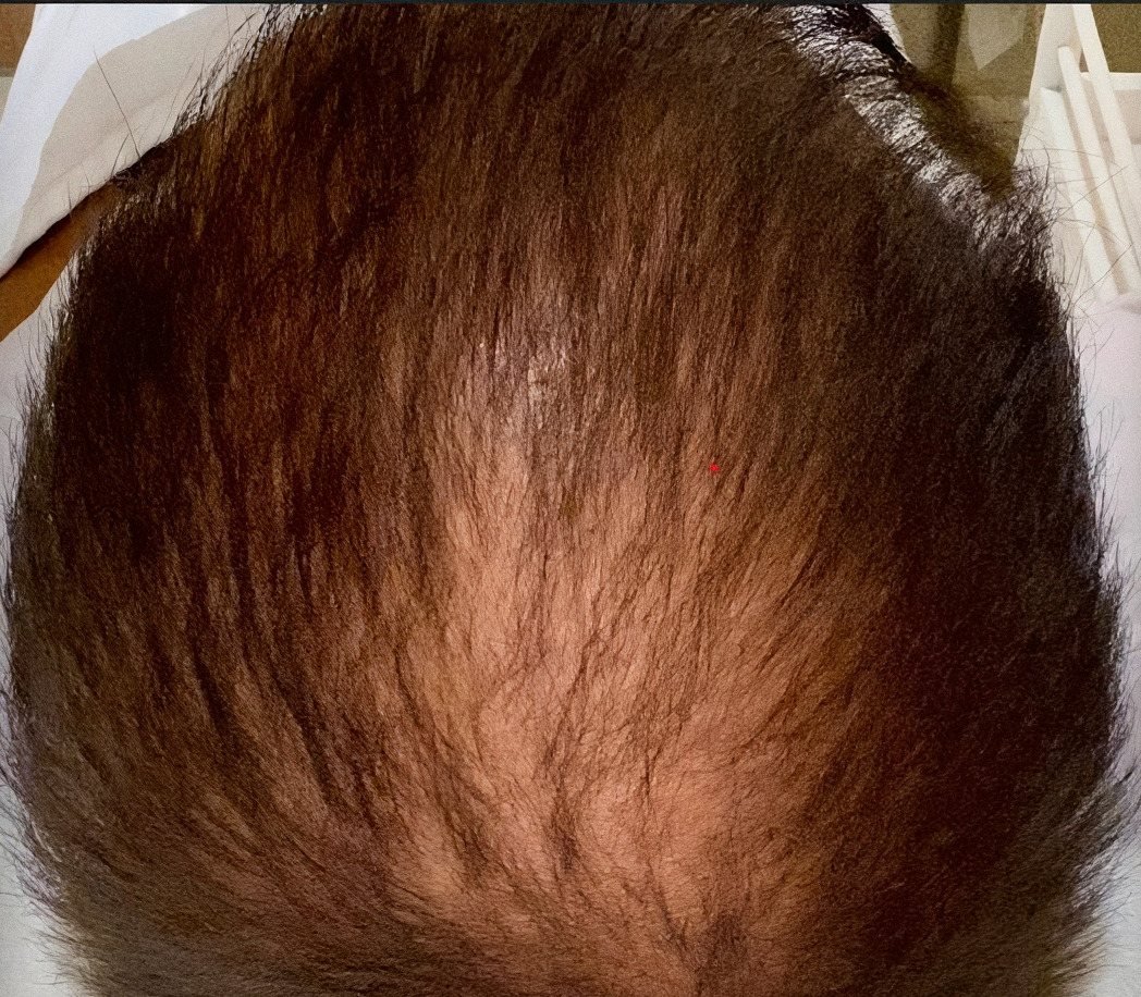 PRP Hair Renewal case 3: scalp from above, 1st session
