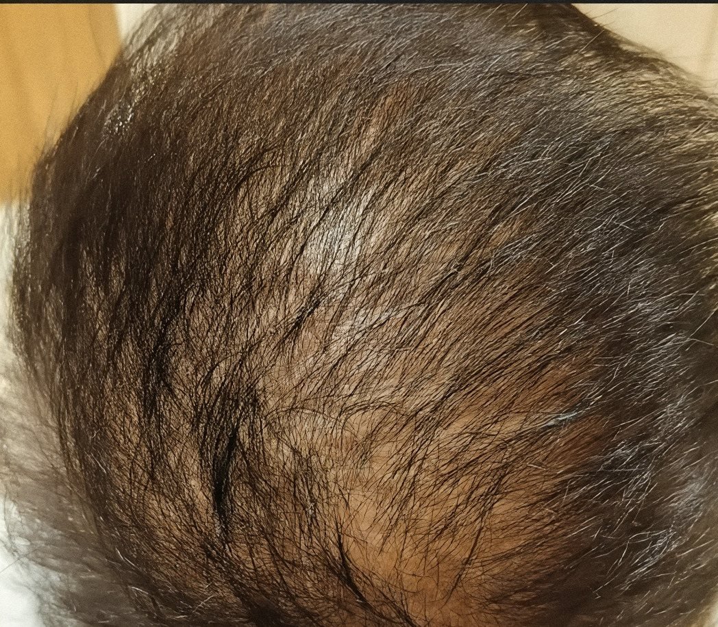 PRP Hair Renewal case 3: scalp from above, 2nd session
