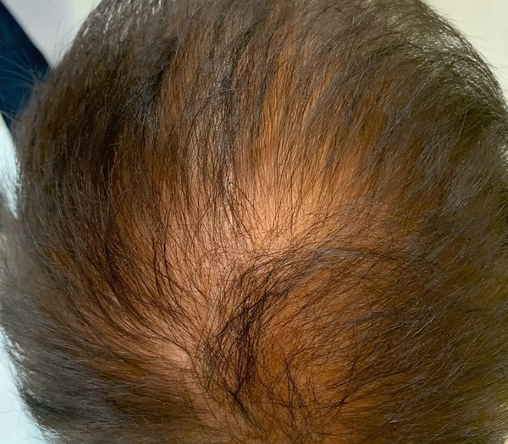 PRP Hair Renewal case 3: scalp from above, before treatment