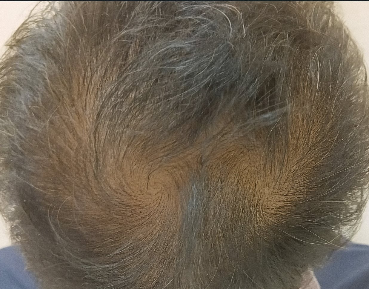 PRP Hair Renewal case 4: scalp from above, 5th session
