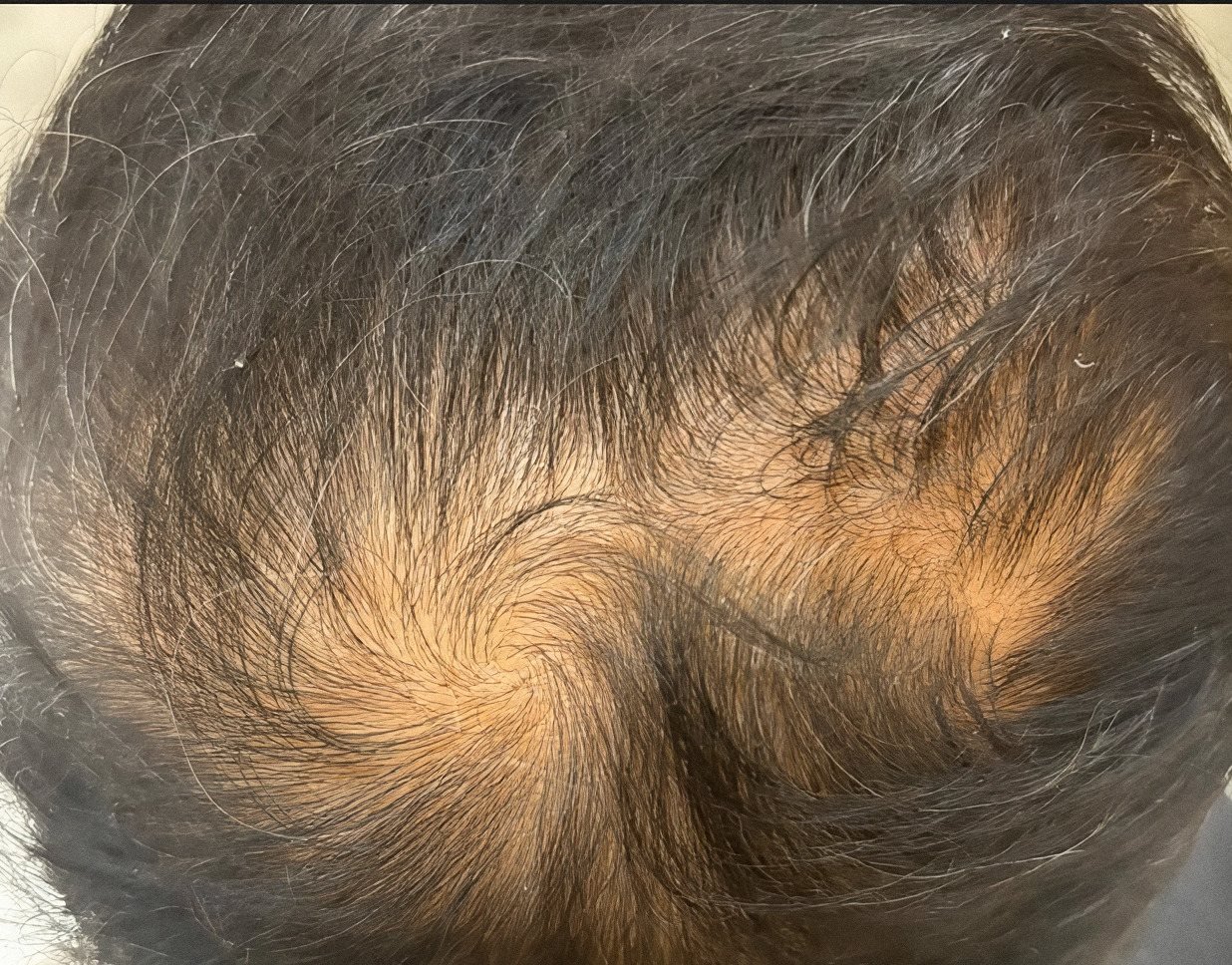 PRP Hair Renewal case 4: scalp from above, before treatment